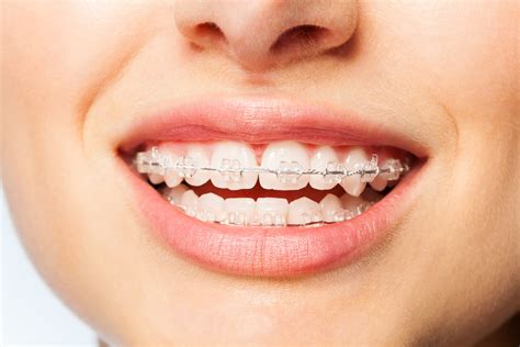 Invisible Braces .